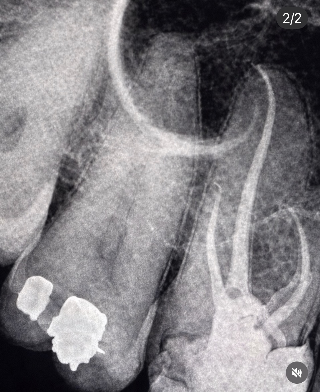 Radiografía anonimizada de molar tratado