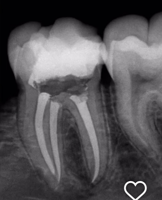 Radiografía anonimizada de endodoncia