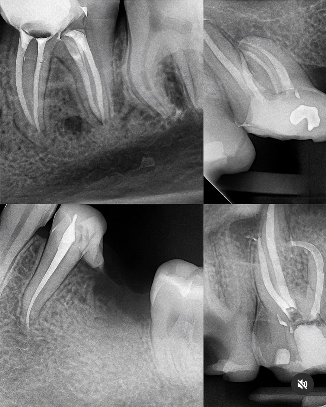 Collage de radiografías de casos endodónticos complejos