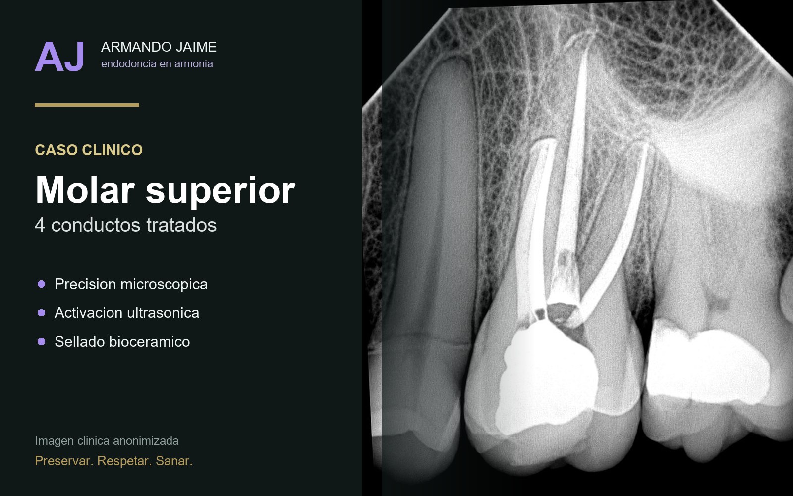 Caso clinico anonimizado de molar superior tratado
