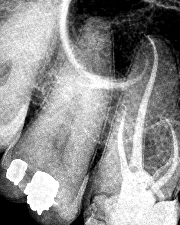 Radiografia anonimizada de endodoncia en molar superior