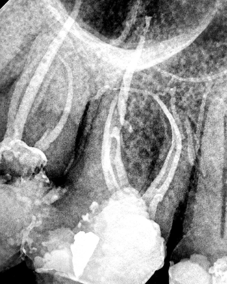 Radiografia anonimizada de tratamiento endodontico complejo