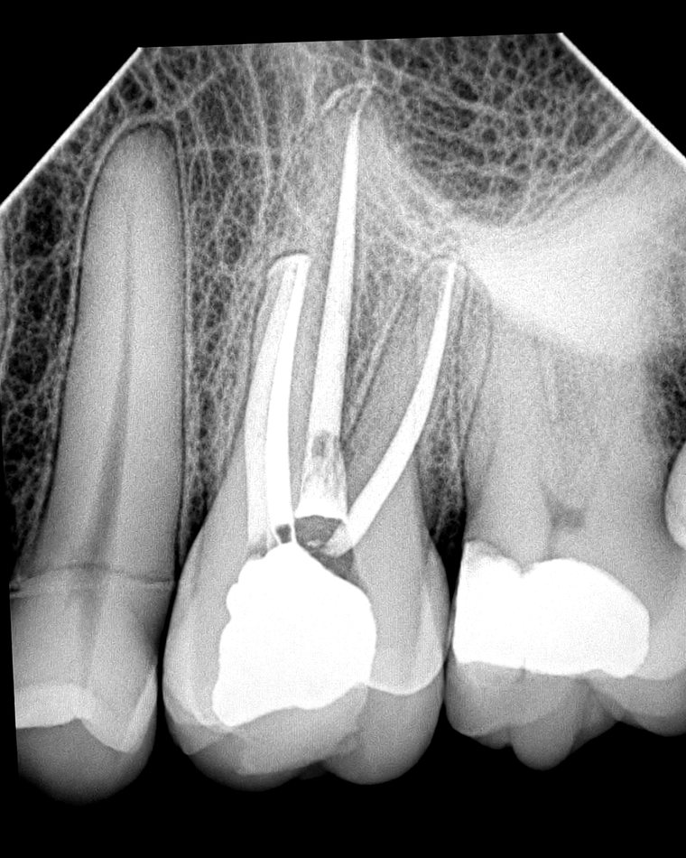 Radiografia anonimizada con tratamiento de cuatro conductos